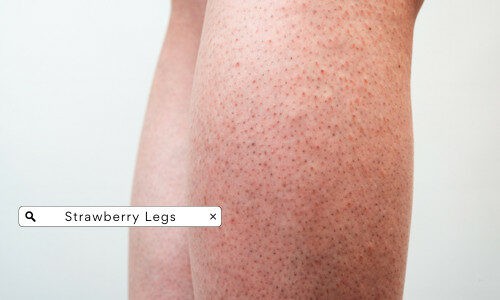 Strawberry Legs- Causes, Treatments & Prevention