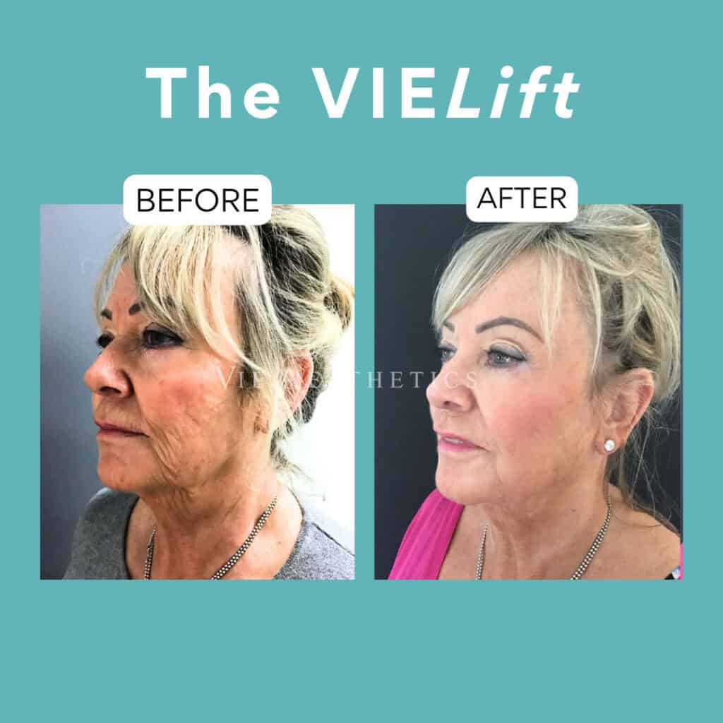 the vielift results pam rose vie aesthetics dr liakas non surgical facelift thread lift filler hydrobooster relife rayleigh essex london holborn harley street