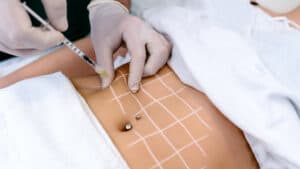 Aqualyx lipolysis body sculpting 