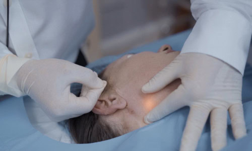 Considering Endolift? Key Facts and Considerations