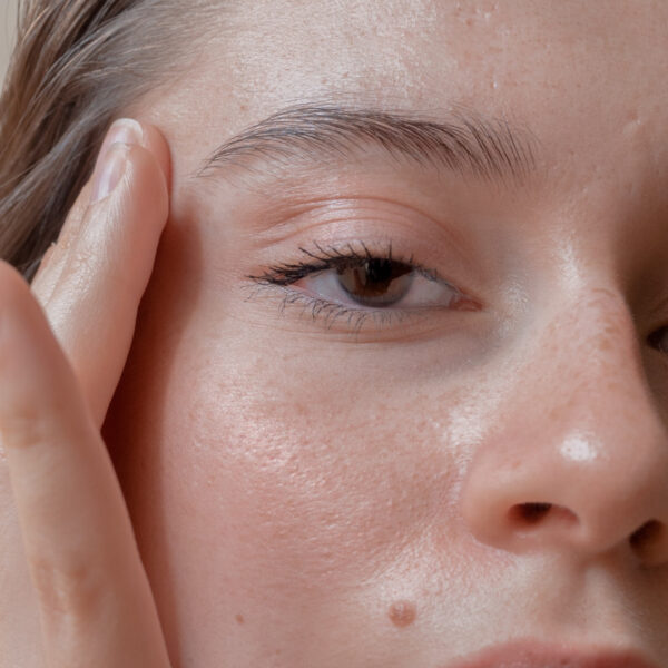 Chemical Peels