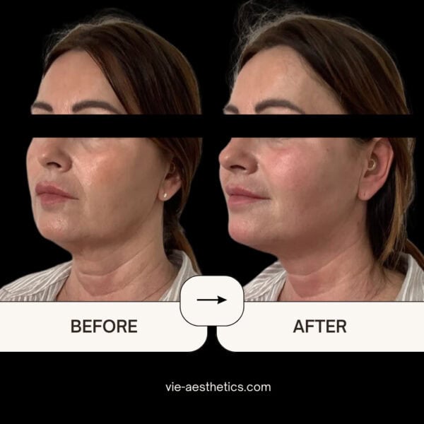 endolift before and after vie aesthetics rayleigh essex holborn london