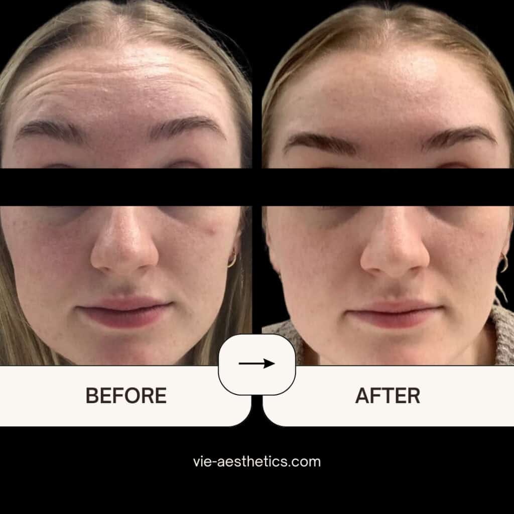 botox before and after vie aesthetics rayleigh essex holborn london