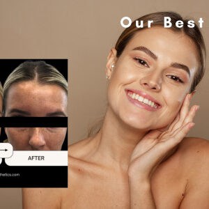 Botox Before and After