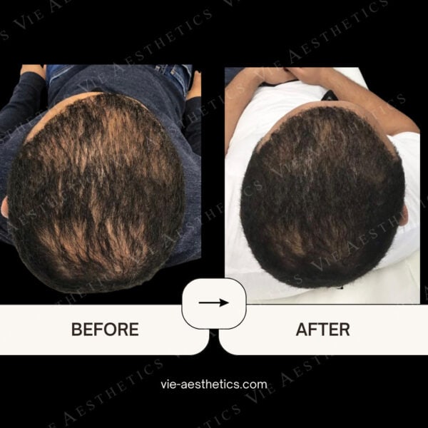 regenera activa before and after micrografting treatment vie aesthetics hair loss treatment rayleigh essex holborn london