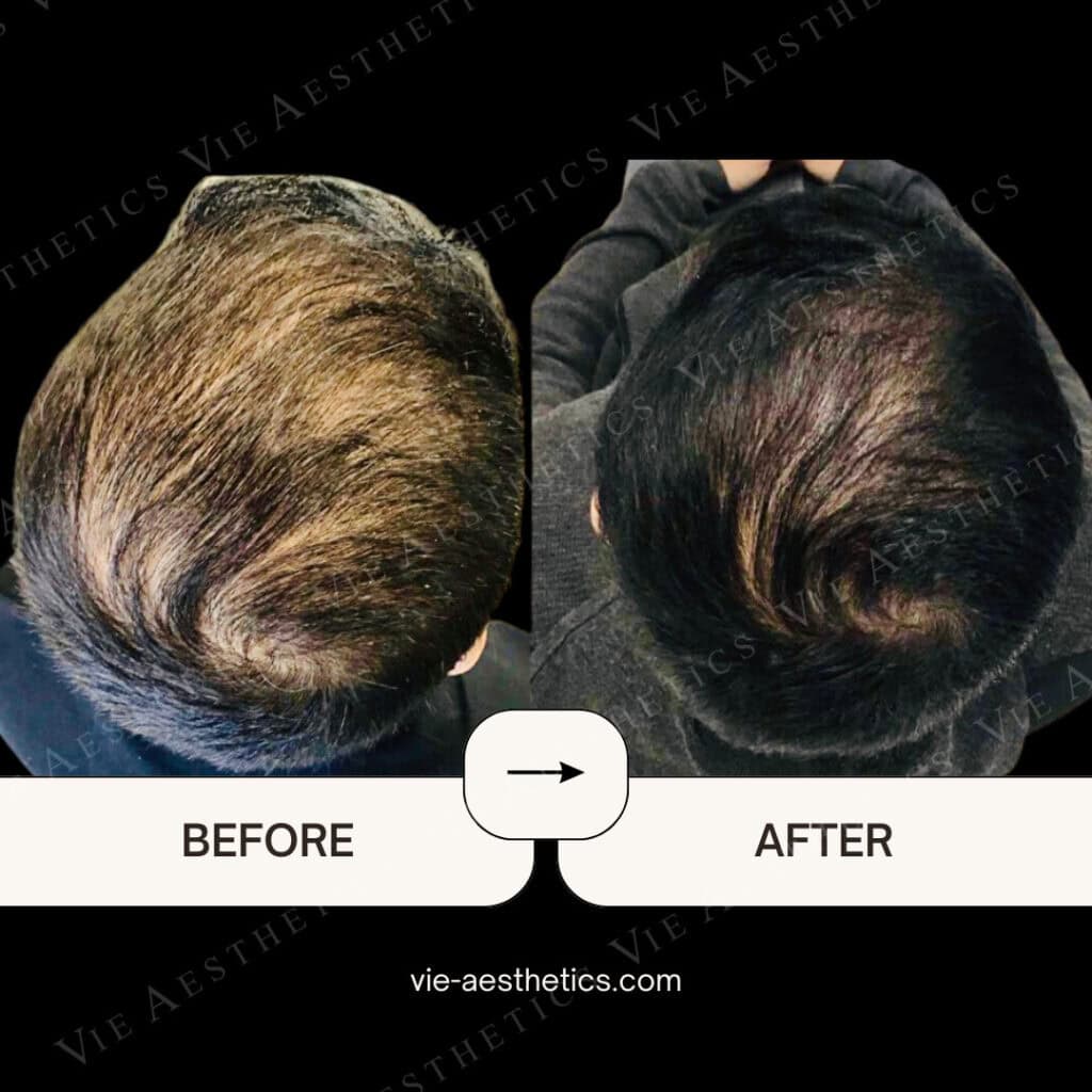 regenera activa before and after micrografting treatment vie aesthetics hair loss treatment rayleigh essex holborn london hair loss