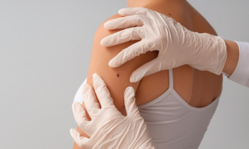 mole removal non surgical no surgery plexr plasma vie aesthetics rayleigh essex holborn london