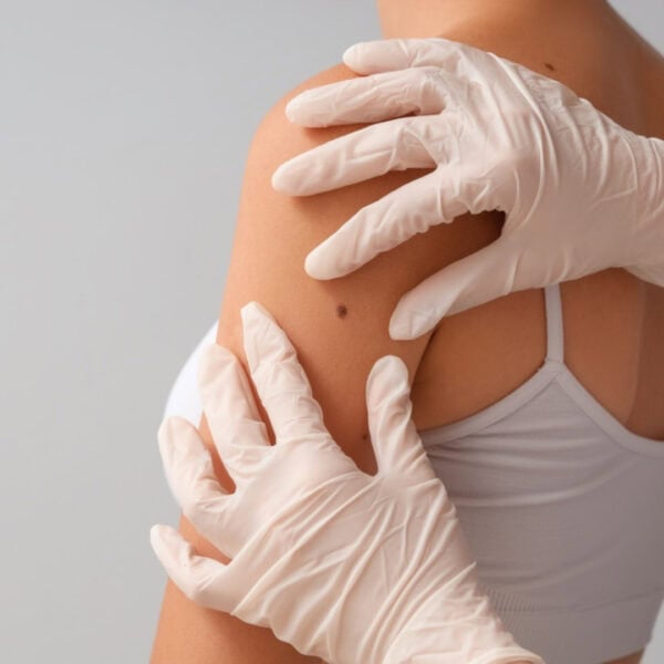 Mole Removal using PlexR Plasma