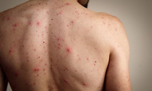 Back Acne in Summer: What Causes It and How to Treat It Safely