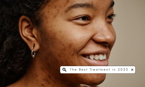 How to Fade Acne Scars This Summer Without Harsh Treatments