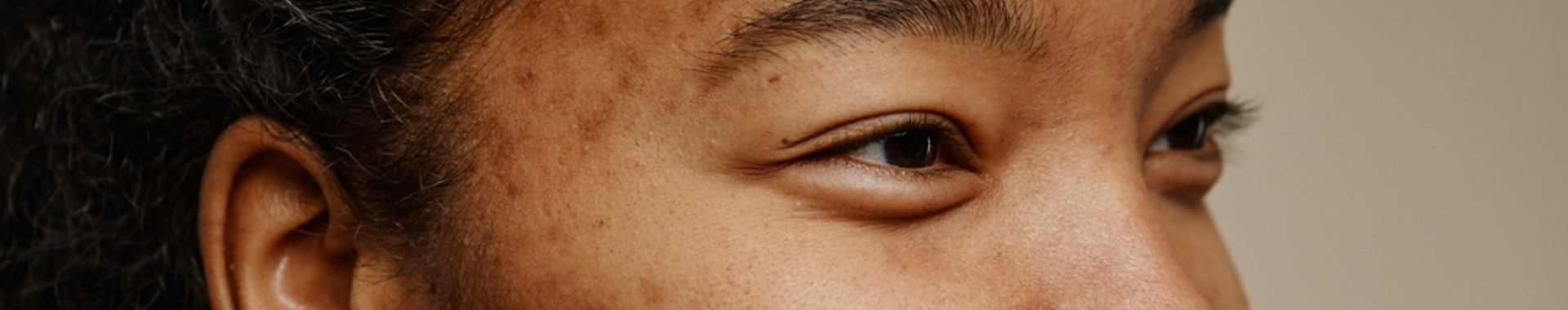 How to Fade Acne Scars This Summer Without Harsh Treatments
