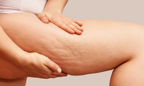 How to Get Rid of Cellulite: What Actually Works bodyshock mesoestetic treatment vie aesthetics rayleigh essex holborn london