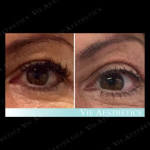 non surgical blepharoplasty plexr eyes before and after vie aesthetics rayleigh essex holborn london