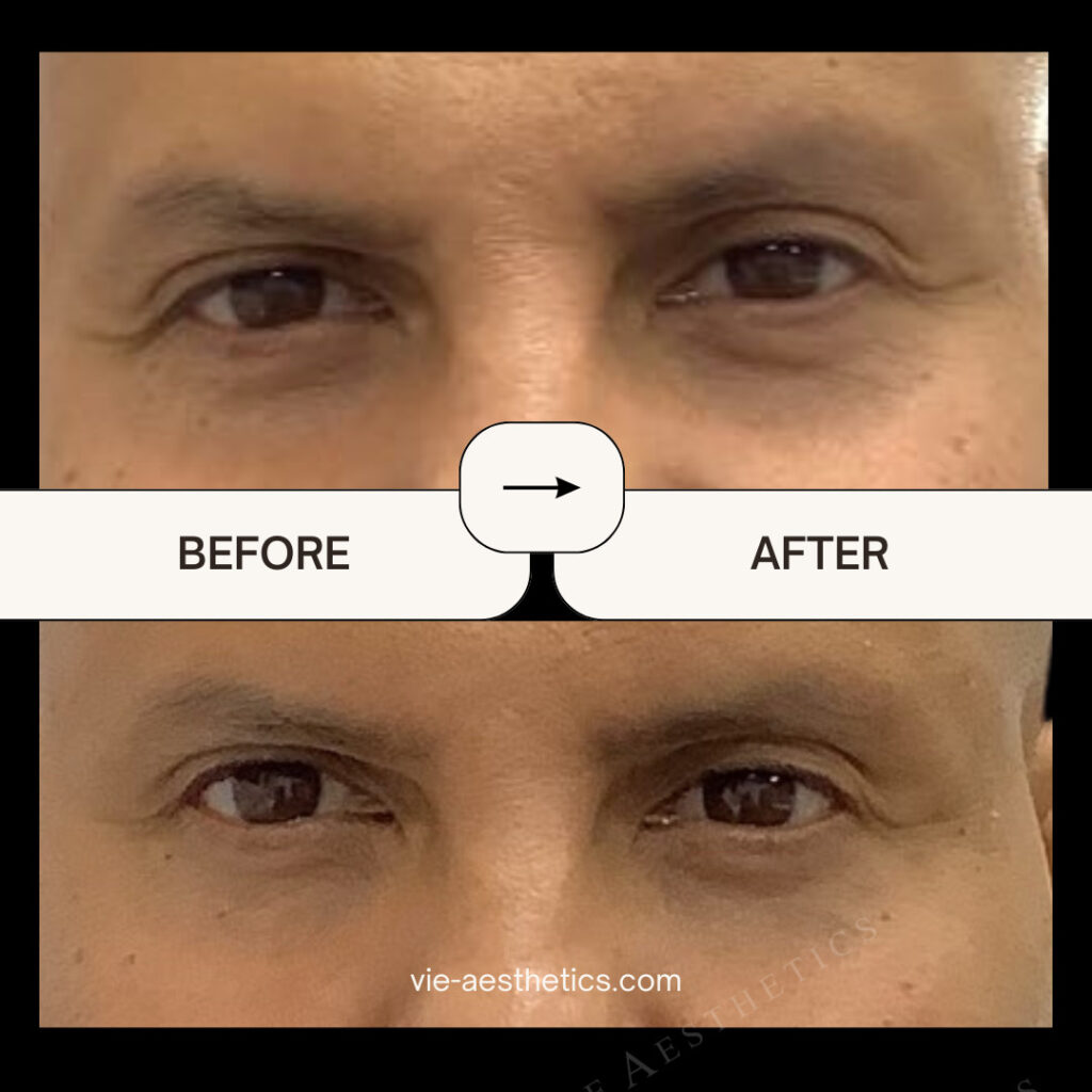 Best Natural Filler for Under-Eye Hollows and Dark Circles plasma gel bio filler before and after