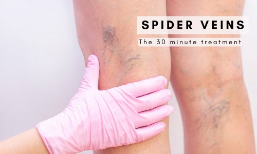 How to Improve Spider Veins & Thread Veins Before Summer