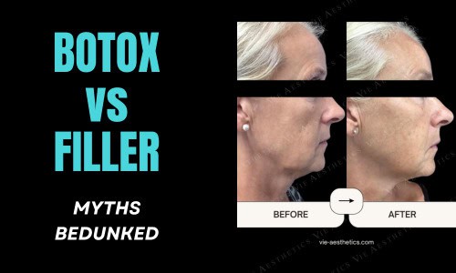 Botox vs Filler: 7 Myths You Shouldn’t Believe