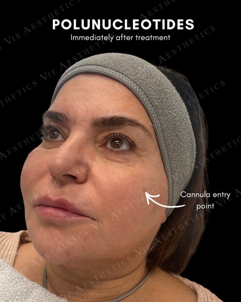Thin Under Eye Skin: Treatment Options POLYNUCLEOTIDES VIE AESTHETICS RAYLEIGH ESSEX HOLBORN LONDON