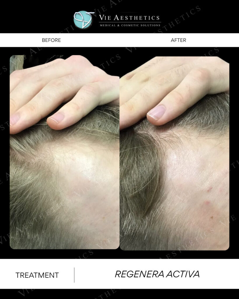 regenera activa before and after vie aesthetics receeding hairline rayleigh essex holborn london