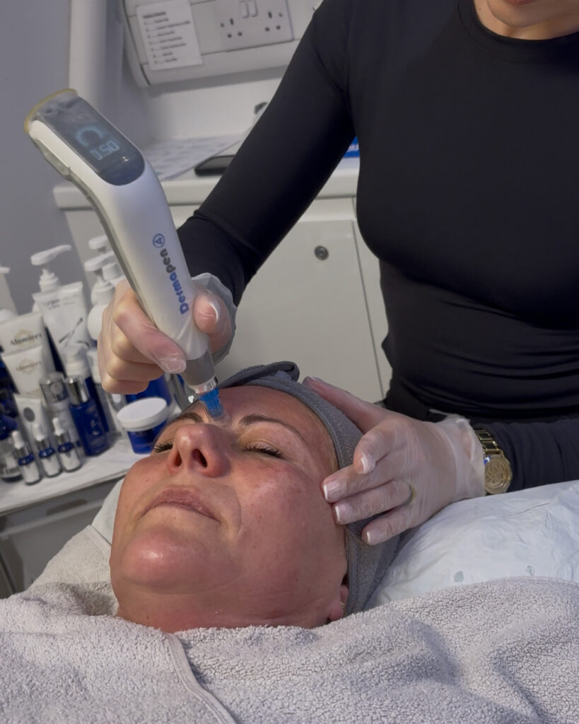 prp microneedling dermapen platelet rich plasma vie aesthetics rayleigh essex holborn london