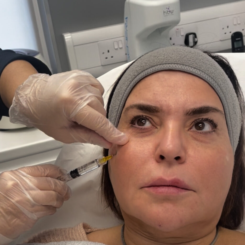 Polynucleotides Under Eyes UK: Benefits, Results and What to Expect vie aesthetics rayleigh essex holborn london