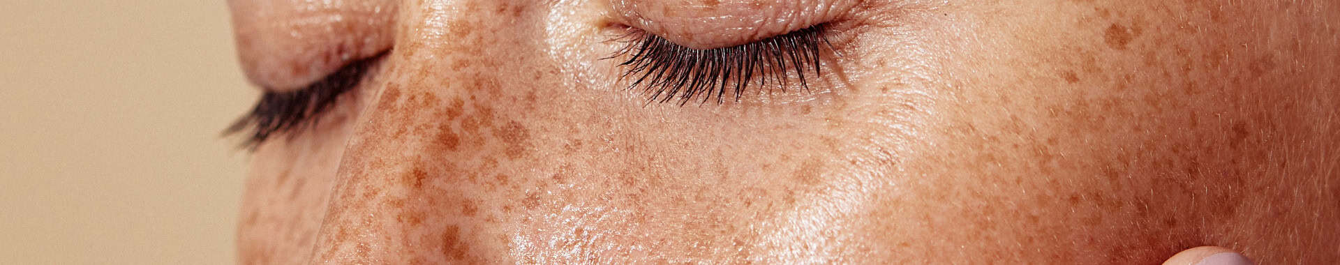 skin pigmentation vs sun damage vie aesthetics rayleigh essex holborn london