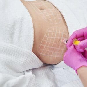 Lemon Bottle Fat Dissolving: Safety, Results, and Medical-Grade Alternatives