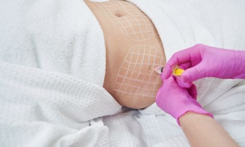 Lemon Bottle Fat Dissolving: Safety, Results, and Medical-Grade Alternatives