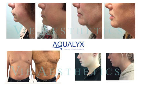 Aqualyx results at Vie Aesthetics
