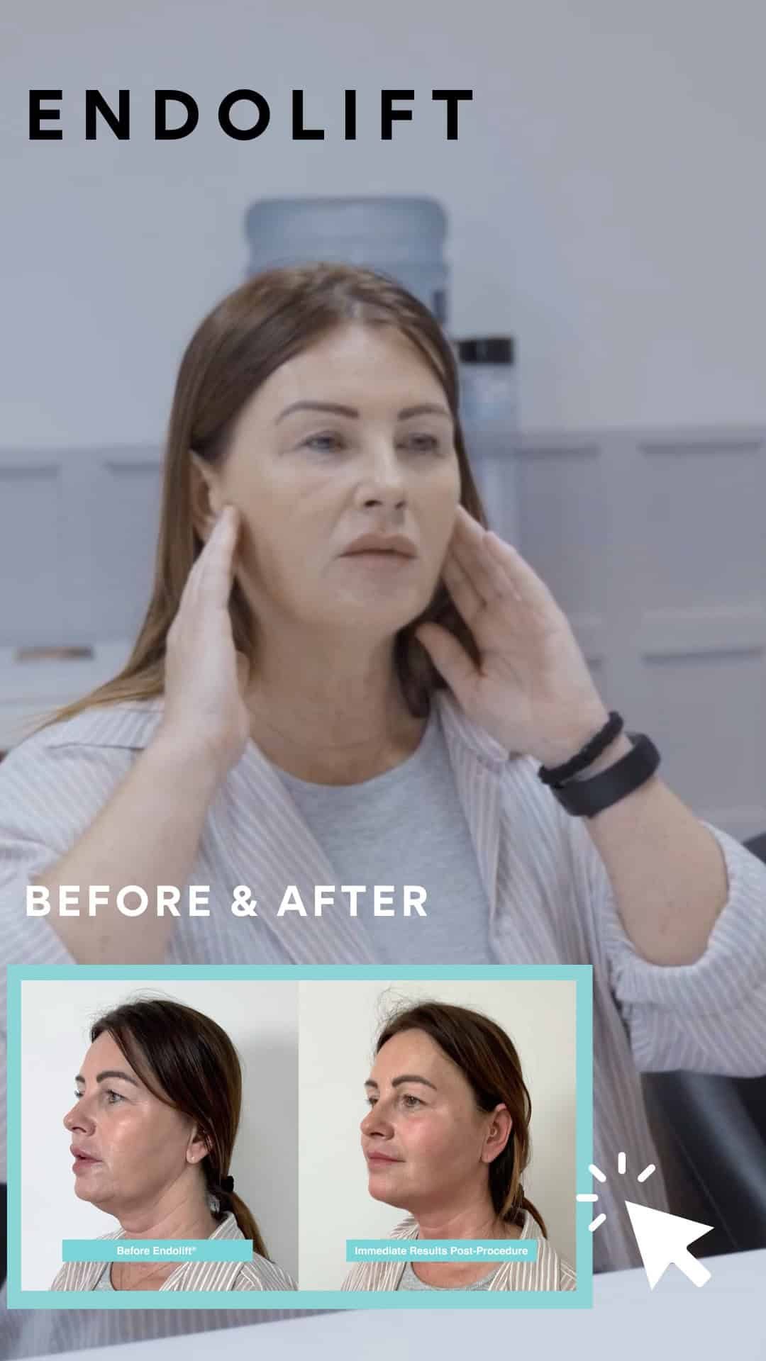 endolift sagging skin after weight loss angie before and after vie aesthetics london holborn rayleigh essex